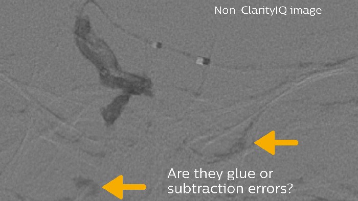 glue and subtraction error