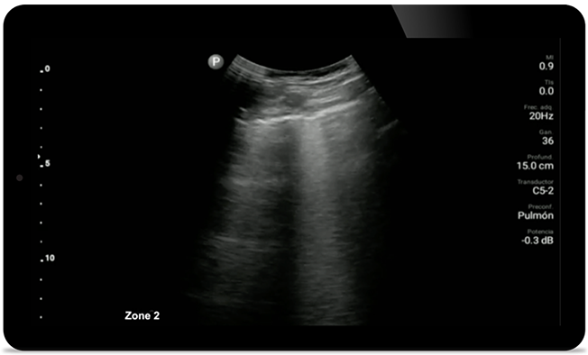 Keep an eye on COVID pneumonia