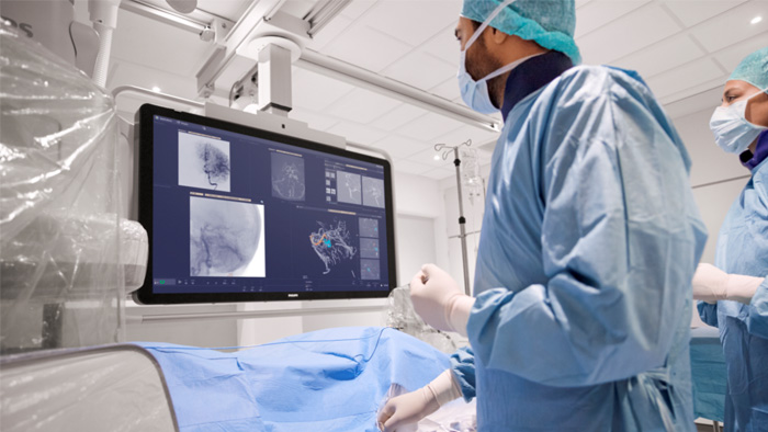 AVM treatment