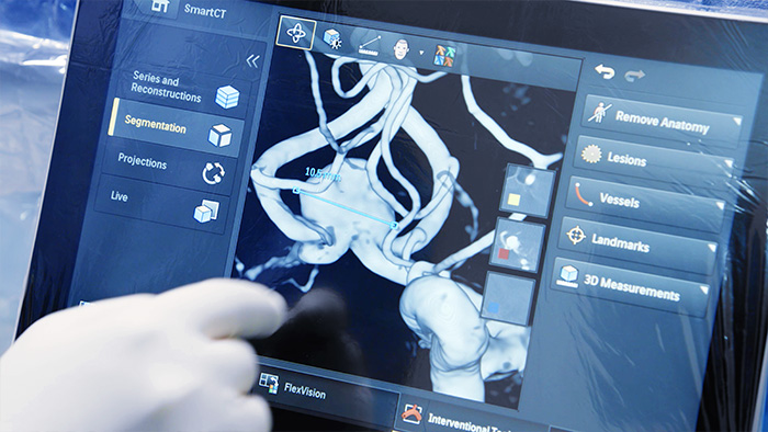 SmartCT Angio